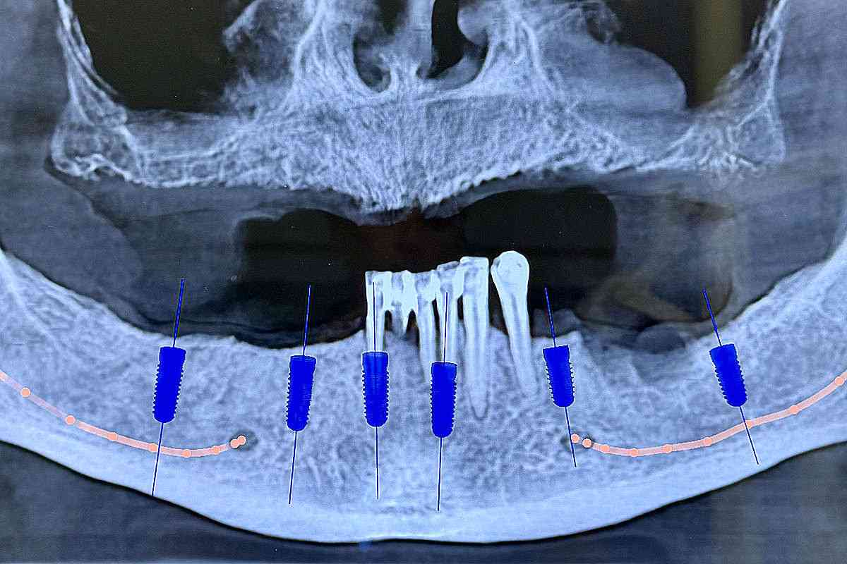 Röntgenaufnahme des Unterkiefers mit digitaler Planung von Implantatpositionen für eine 3D-navigierte Implantation.